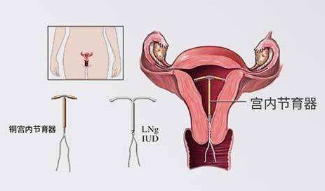 固原节育环注意事项,节育环年限,上环条件,